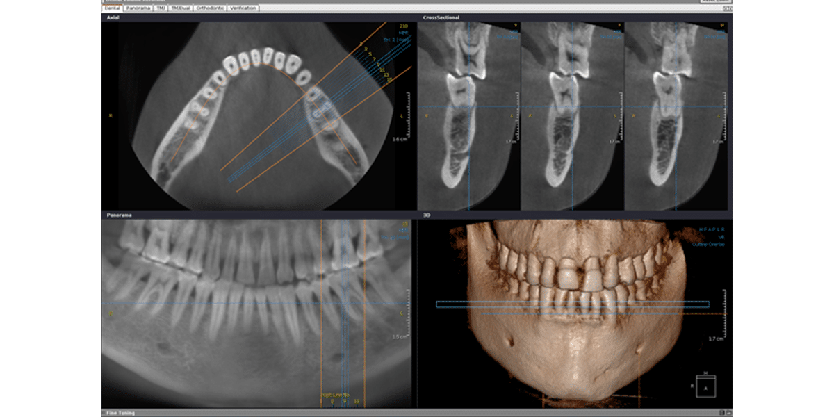 Снимок зубов видное. Кт 3d верхней и нижней челюсти. Компьютерная томография челюсти снимок. Дентальная 3d кт челюсти. КЛКТ верхней и нижней челюсти.